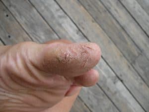 Mark's toe cracks — 30 years of heel fissures