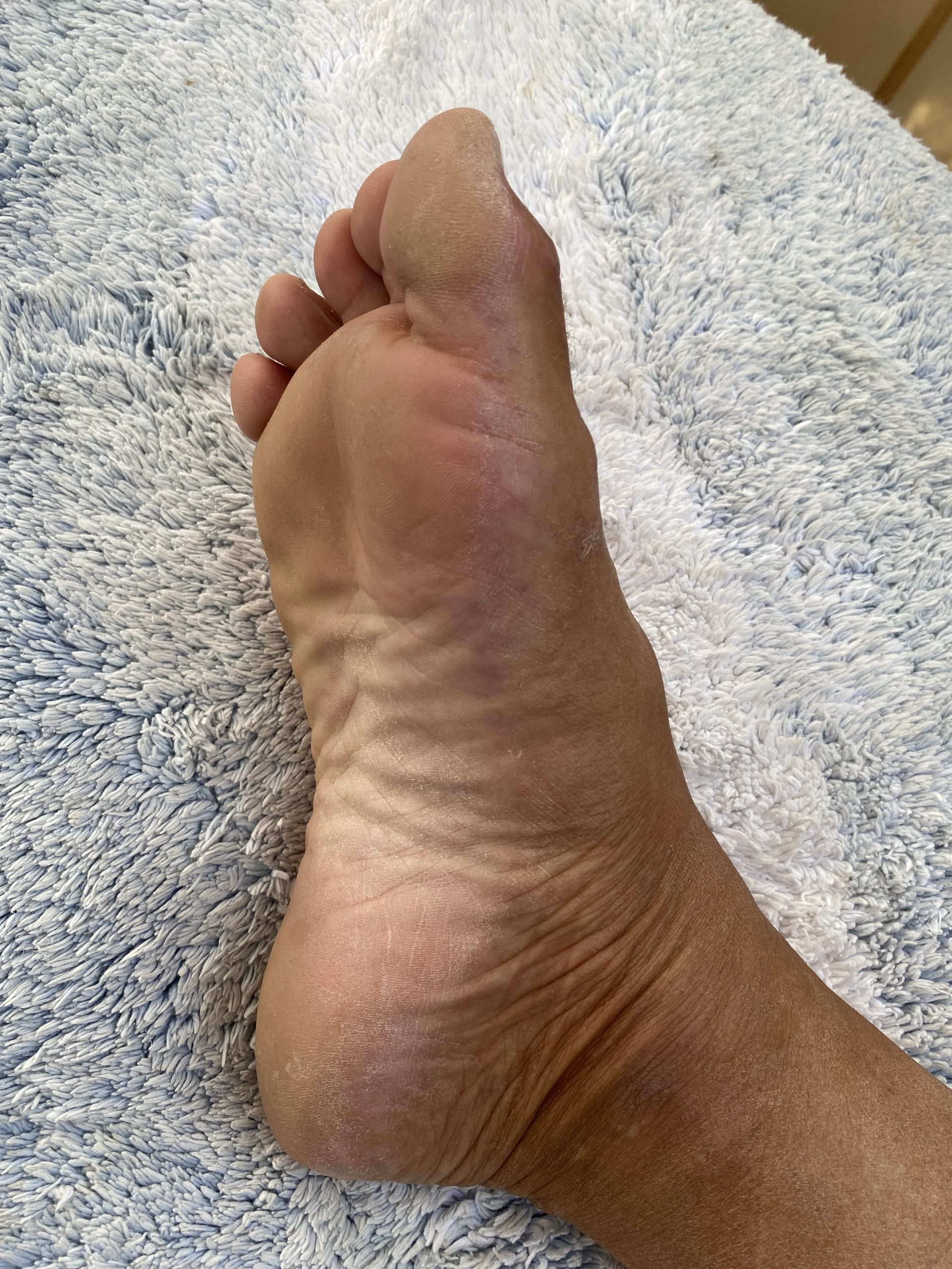 Mark's foot — healthy skin in 2026, maintained with LiveO2